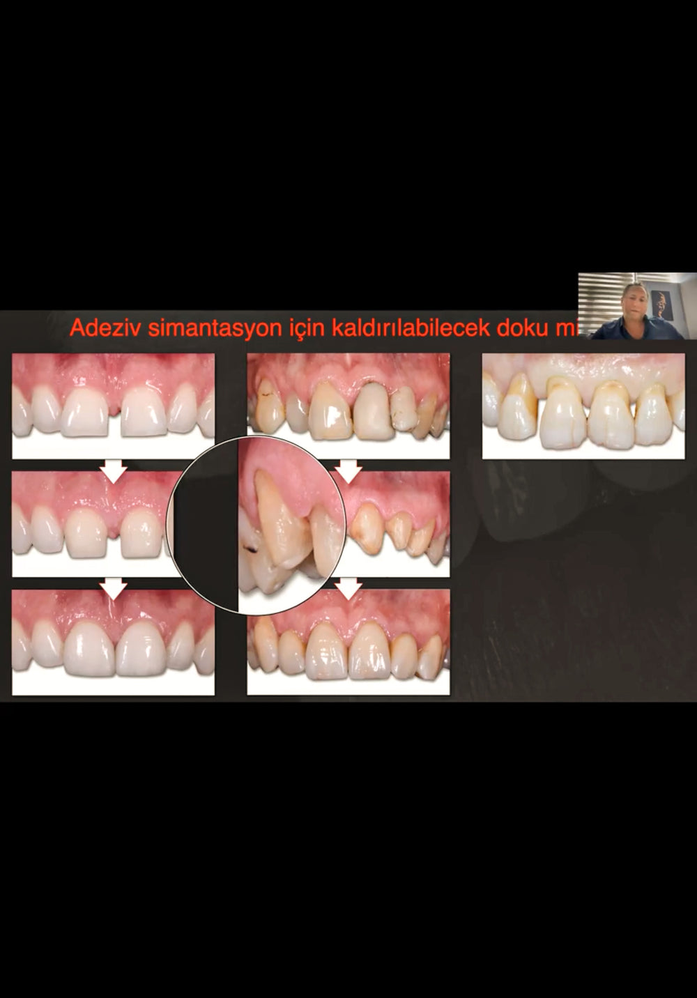 Estetik Gülüş Tasarımında Porselen Lamina Veneerler